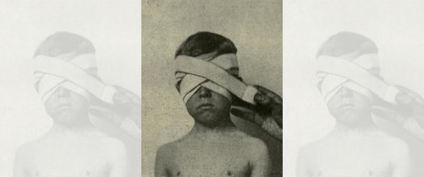 Edward Temples Eye Disorder