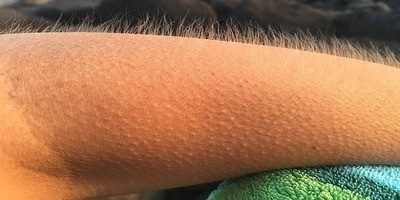Goose bumps